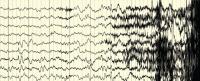 An EEG recording showing brain wave patterns, indicative of an epileptic seizure.